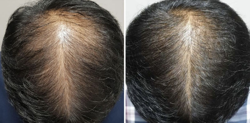 Before and 1 month after procedure, with Dr. Joshua Chong Singapore