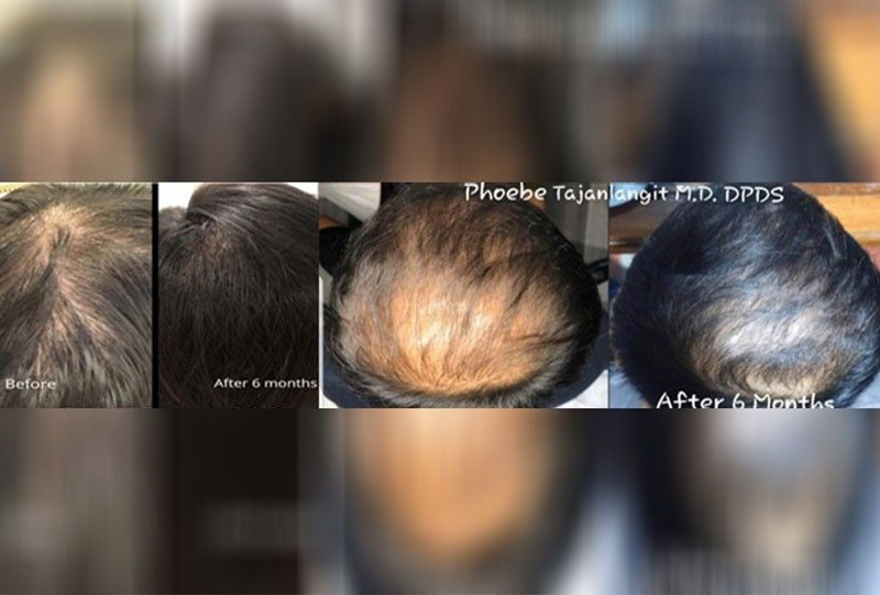 Regenera results after six months on Dr. Phoebe Tajanlangit’s patients