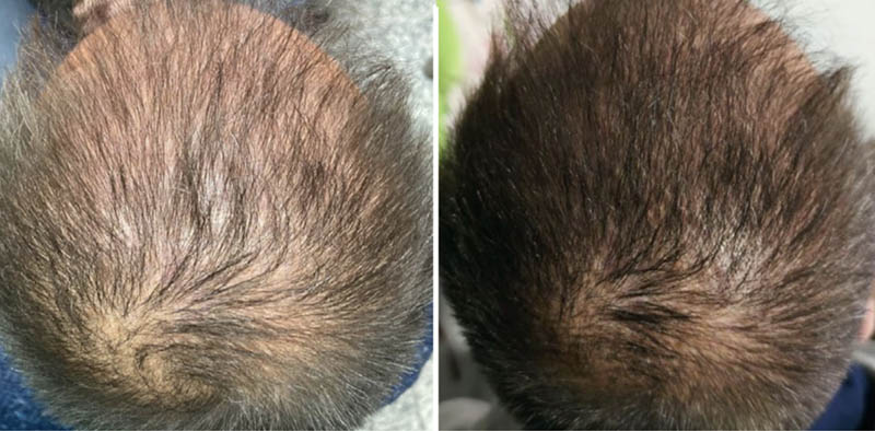 Results from Spain-based Dr. Nur Masbout