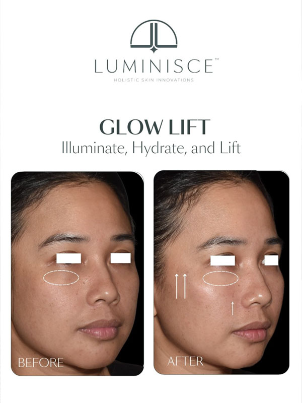 Glow Lift