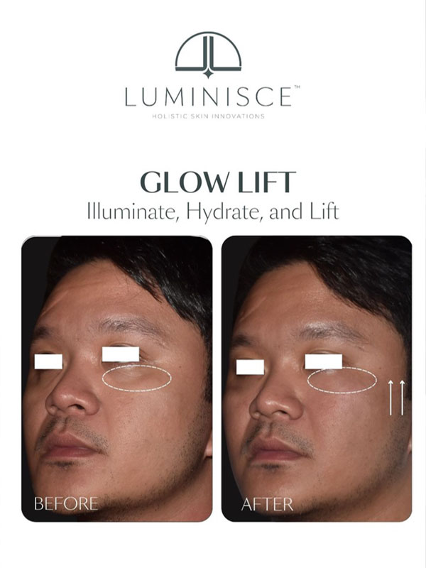 Glow Lift